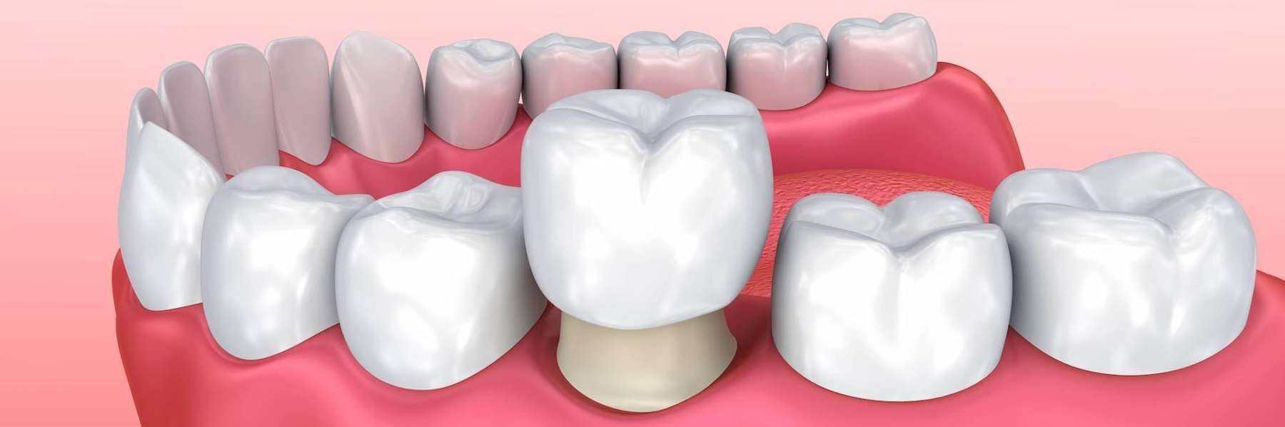 pediatric dental crowns